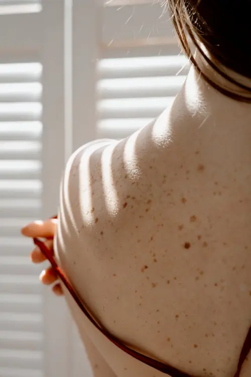Melanoma avanzato, UniTS guida EXOMEL per cure più mirate con biopsia liquida